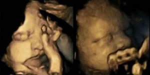 Insolite : Un fœtus fait la grimace quand sa maman fume !