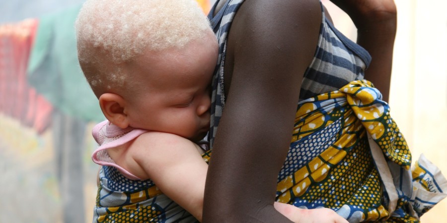 Tués par le soleil, transformés en objets sacrificiels par certains hommes : Le calvaire des albinos…