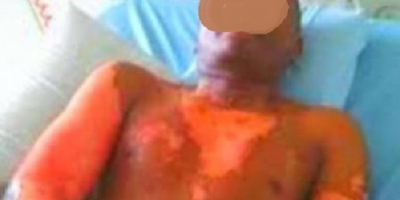 La polygamie vire au drame : La première femme ébouillante son mari avec de l’amidon mélangé à du piment