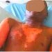La polygamie vire au drame : La première femme ébouillante son mari avec de l’amidon mélangé à du piment