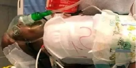 hôpital Albert Royer : Rappel à DIEU de l’une des jumelles siamoises, trois jours le succès de l’opération