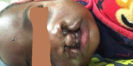 Santé : la maladie dite « bec-de-lièvre », une affection « sous-évaluée » au Sénégal