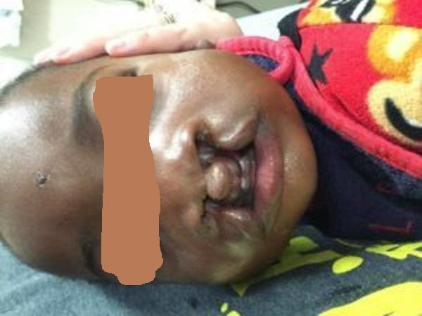 Santé : la maladie dite « bec-de-lièvre », une affection « sous-évaluée » au Sénégal
