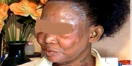 La santé publique face à la dépigmentation artificielle ou xessal : Des dermatologues alertent sur une mortalité de l’ordre de 100%, ces 4 derniers mois