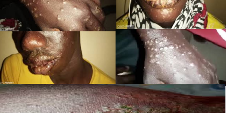 Boutons sur les mains, visage lacéré…Une maladie mystérieuse s’attaque aux pêcheurs de Thiaroye sur mer qui soupçonnent un produit déversé en mer