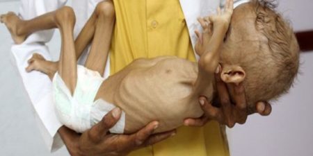 Guerre et urgence humanitaire au Yémen : des enfants qui meurent de faim ne pleurent pas.
