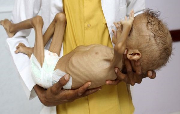 Guerre et urgence humanitaire au Yémen : des enfants qui meurent de faim ne pleurent pas.