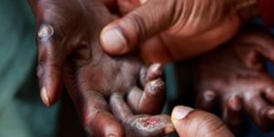 Lutte contre la Lèpre : La discrimination et la stigmatisation persistent