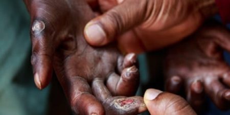 150 nouveaux cas de lèpre détectés en 2022 au Sénégal : Diourbel, Kaolack, Dakar et Thiès, les régions les plus touchées par la maladie