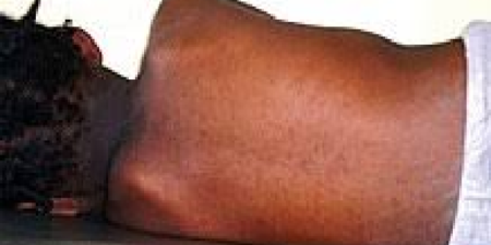 Alerte Santé au Togo : cas de rougeole signalés dans cinq districts