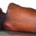 Recrudescence de la rougeole au Sénégal : 410 cas confirmés, Diourbel en tête