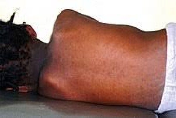 Recrudescence de la rougeole au Sénégal : 410 cas confirmés, Diourbel en tête