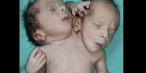 Inde : l’incroyable naissance d’un bébé à deux têtes, trois bras et deux cœurs