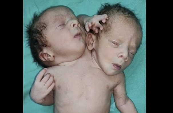 Inde : l’incroyable naissance d’un bébé à deux têtes, trois bras et deux cœurs