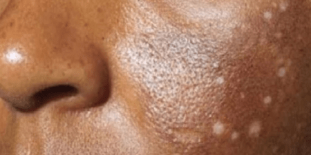 Chiffres alarmants sur la dépigmentation artificielle : les dermatologues rectifient Vox Populi et livrent la bonne version…