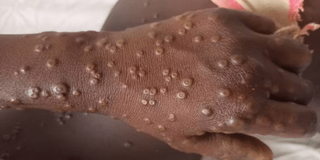 Santé publique : Le Sénégal en alerte face à la Fièvre de la Vallée du Rift et au Mpox