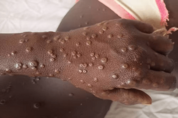 Mpox : Le monde doit tirer les leçons du Covid-19   Par David Thomas