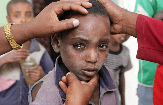 Le Sénégal élimine le trachome : une victoire majeure en santé publique saluée par l’OMS