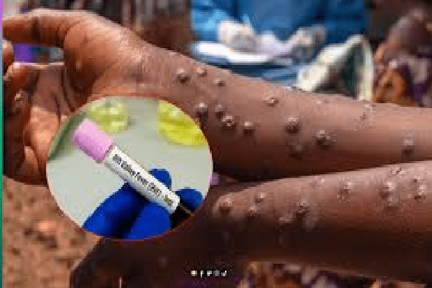 Santé publique : la Fièvre de la Vallée du Rift atteint Keur Massar, 196 cas recensés au Sénégal